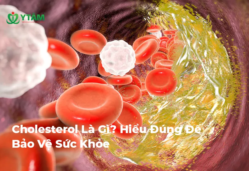 4. Ảnh hưởng của cholesterol cao